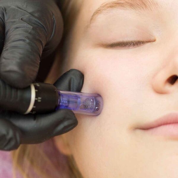 Microneedling (dermapen)