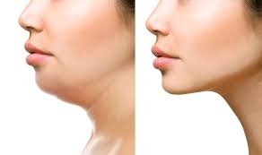 Lipopapada con Kybella