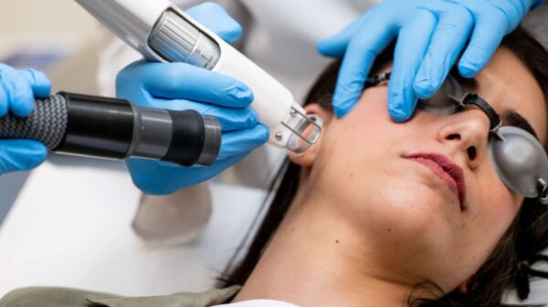 Laser para Melasma 3 Sesiones