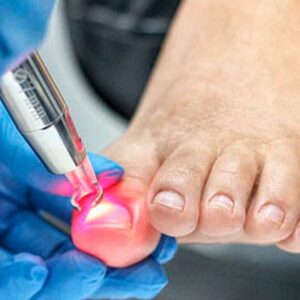 Laser para Micosis Ungueal  (Hongo) 5 Sesiones