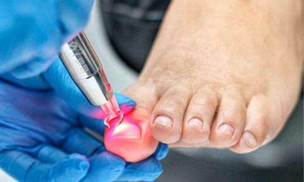 Laser para Micosis Ungueal  (Hongo) 5 Sesiones