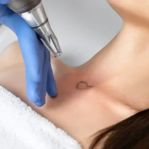 Eliminación de Tatuajes con Laser