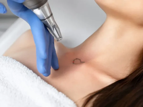 Eliminación de Tatuajes con Laser