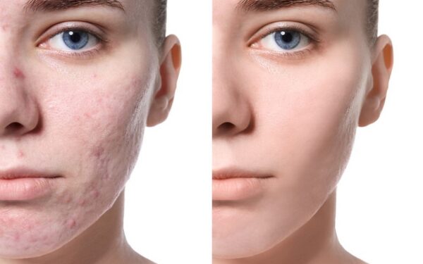 Laser para el Acné 3 Sesiones