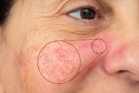 Laser Talagestacia
