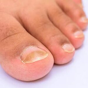 Tratamiento para micosis