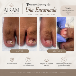 Tratamiento de uña encarnada